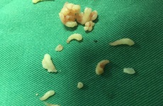 Lấy gần 20 chiếc răng cho bé 12 tuổi bị khối u răng hiếm gặp