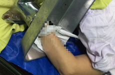 Người phụ nữ mang máy xay thịt chứa bàn tay dập nát đến bệnh viện