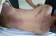 Phạm nhân tử vong trong trại giam với nhiều vết bầm tím