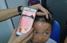 Tin vui cho người mắc bệnh bạch biến