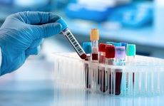 Phương pháp giá rẻ xác định 5 loại ung thư trước đến 4 năm