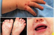 Bệnh tay chân miệng trẻ em bùng phát ở Lâm Đồng