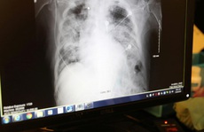 Bệnh nhân xui xẻo, chết vì ghép phổi chứa virus SARS-CoV-2