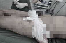 Cứu sống nam thanh niên bị ống sắt lan can đâm xuyên đùi