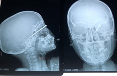 Bé trai 8 tuổi bị mũi tên bắn xuyên mắt, găm sâu vào sọ não