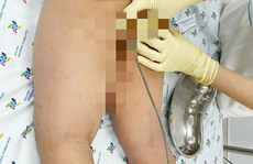Bắt chước trong phim, bé trai nhét cây thông cống nửa mét vào hậu môn