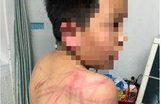 Lãnh đạo TP Đà Lạt thăm hỏi cháu trai 10 tuổi bị cha bạo hành dã man