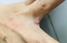 Ca đậu mùa khỉ đầu tiên ở Việt Nam hiện ra sao?