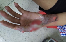 TP HCM: Nhiều bệnh nhi dập nát bàn tay vì đốt pháo tự chế
