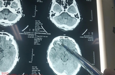 Vụ người dân tố bị đánh chấn thương sọ não: Có kết quả giám định ghi âm