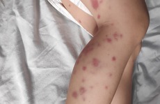 Bé trai lộ bệnh như bị 'bạo hành' khiến cha mẹ một phen sợ hãi