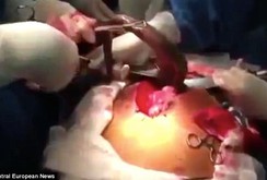 Kinh hãi cá sống trong bụng người