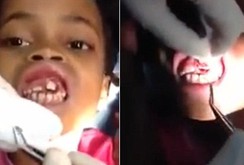 Kinh hãi giòi trong miệng bé gái 10 tuổi