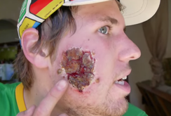 Vi khuẩn “ăn thịt người” tấn công phiến quân IS