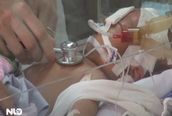 Vụ trẻ sơ sinh bị đâm vào đầu: Bé vẫn đang hôn mê