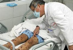 Viêm não mô cầu nguy hiểm như thế nào?