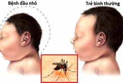 Bản tin NLĐ ngày 1-11: 23 trường hợp nhiễm zika; đã có ca hội chứng đầu nhỏ