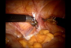 Lần đầu tiên dùng robot mổ ca ung thư dạ dày tại Bệnh viện Bình Dân