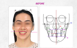 Cân chỉnh đường giữa và chữa lệch mặt bằng phương pháp niềng răng