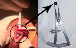 Viên bi sắt 6 mm nằm trong mí mắt nam sinh 15 tuổi suốt nhiều ngày
