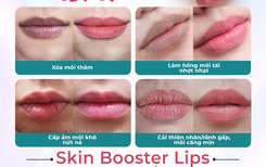 Top 3 nơi "trẻ hóa môi" uy tín tại TPHCM