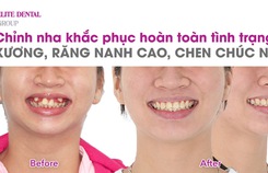 Để có một hành trình niềng răng suôn sẻ, cần lưu ý những điểm sau Để có một hành trình niềng răng suôn sẻ, cần lưu ý những điểm sau