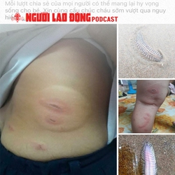 Sự thật vụ việc bé 3 tuổi "bị sâu biển cắn nguy kịch"