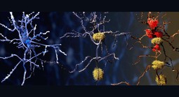 Phát hiện thủ phạm tiềm năng mới của bệnh Alzheimer