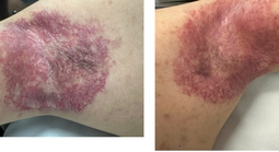 Bất ngờ từ ca bệnh da di truyền hiếm gặp đáp ứng botulinum toxin