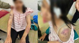 Thông tin mới vụ bé gái 13 tuổi bị tra khảo, đánh đập dã man, người chi chít vết thương