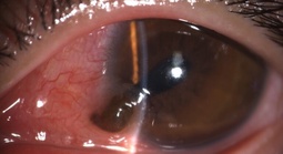 Khẩn cứu người đàn ông bị đinh bắn vào mắt