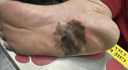 Đốm đen trên da có phải là dấu hiệu ung thư da?