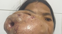 Người phụ nữ mang khối u khổng lồ trên mặt suốt nhiều năm