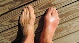 Phương pháp mới hứa hẹn trị cùng lúc bệnh gout và gan nhiễm mỡ