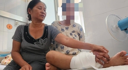 Tin vui với cô gái trẻ mang song thai bị tai nạn lao động phải ghép bàn tay vào chân