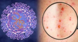 Xuất hiện ca bệnh đậu mùa khỉ chưa rõ nguồn lây ở Đồng Nai