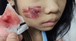 Khỉ hoang tấn công, bé gái 7 tuổi nhập viện