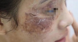 Cô gái bị tàn phá dung nhan vì bôi kem mua trên mạng