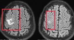 Co giật do sán não suýt nhầm lẫn với u não