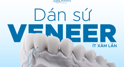 Làm đẹp nụ cười trước Tết: Xu hướng Veneer an toàn được nhiều người lựa chọn