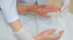 Bồn cầu phát nổ sau khi đổ hóa chất, người phụ nữ bỏng nặng