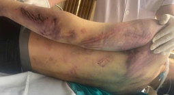 Tạm giữ 8 người liên quan đến vụ học viên 17 tuổi tử vong tại trung tâm công tác xã hội