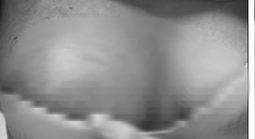 Hoại tử ngực vì tiêm chất làm đầy