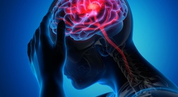 Đột quỵ gia tăng: Nghiên cứu Mỹ hé lộ thủ phạm mới