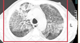 Nam lao động từ Thái Lan về nước nguy kịch vì Whitmore