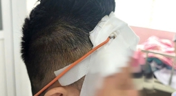 Ngã xe máy, một tháng sau mới lộ chấn thương sọ não