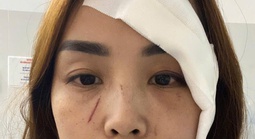 Một phụ nữ ở Nha Trang tố cáo "bị người không quen biết rạch mặt"
