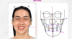 Cân chỉnh đường giữa và chữa lệch mặt bằng phương pháp niềng răng