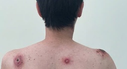 Vết loét tự lành – Dấu hiệu ban đầu của căn bệnh tình dục chết người