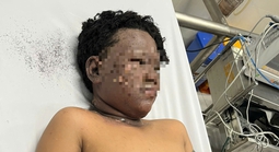 Bé trai với gương mặt cháy đen tự chạy về nhà để người thân đưa đi bệnh viện